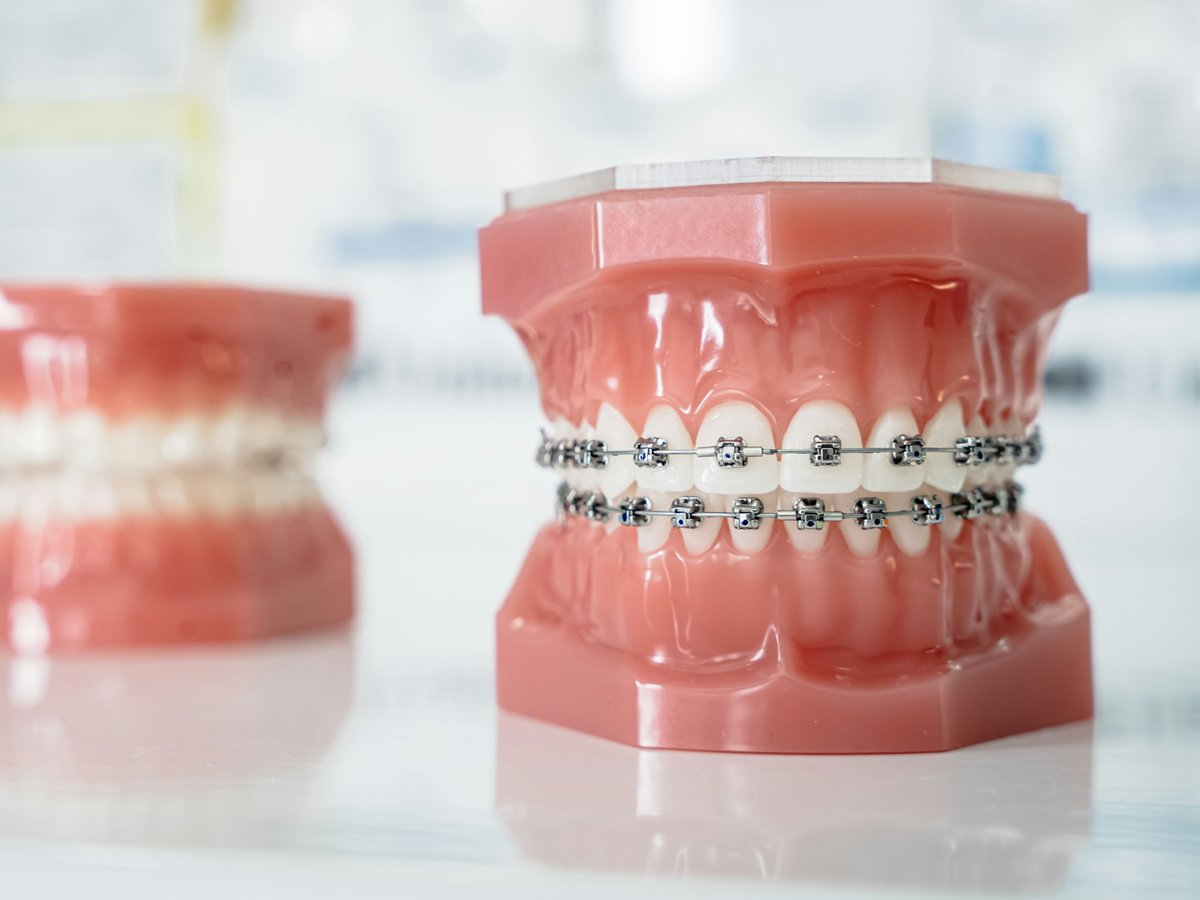 Metal braket ve ark teli ile sabit ortodontik tedavi (diş teli) – üst ve alt çenede braket dizilimi