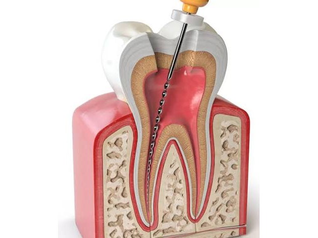 Kanal tedavisi (endodonti) – diş kesiti üzerinde anlatım görseli