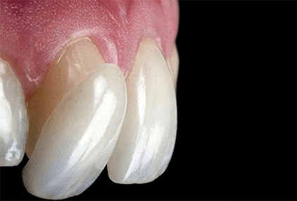 Lamine Veneer (Yaprak Porselen) – DentaNoya Bornova İzmir