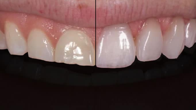 Lamine veneer öncesi ve sonrası: renklenmiş ön dişin yaprak porselen ile estetik dönüşümü